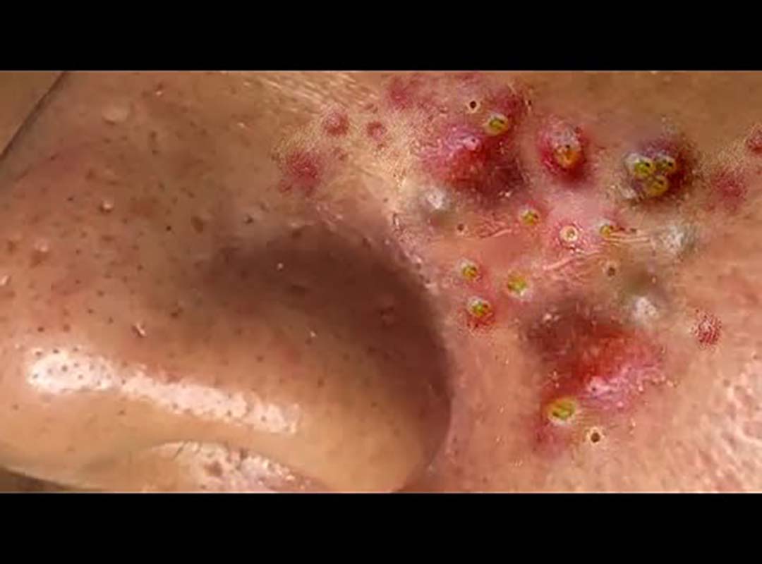 Top New Video BlackHead #4