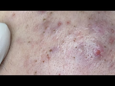 Derm Reacts to Massive Blackhead Removal 👇👇 Watch Full Video